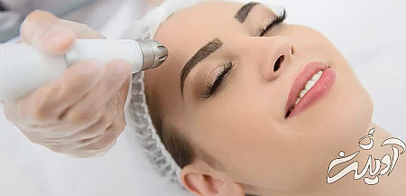 روش از بین بردن جای جوش از بین بردن قرمزی جای جوش صورت, از بین بردن جای جوش با لیزر, راه های از بین بردن جای جوش